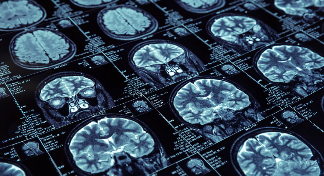 Røntgenbillede af hjerner.