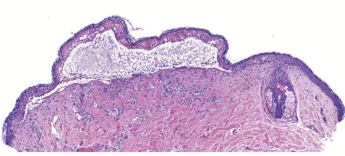 Histology image of TEN